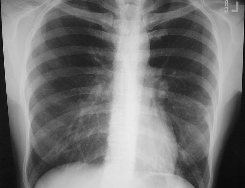 Hình ảnh bệnh nhân bị viêm phổi trên phim chụp X - quang