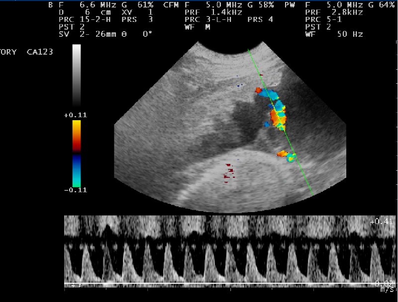 Một hình ảnh thu được sau khi siêu âm doppler thai