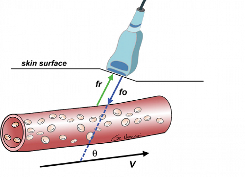 Thủ thuật siêu âm doppler thường ghi nhận sự chuyển động của dòng máu trong cơ thể