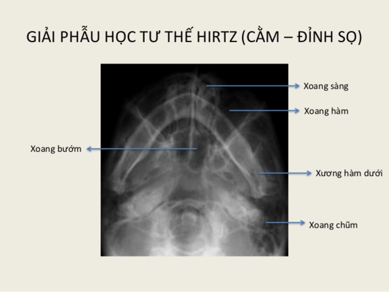 chụp x quang viêm xoang