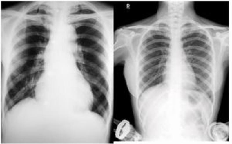 Chụp X - quang phổi có vết mờ là biểu hiện của bệnh gì?