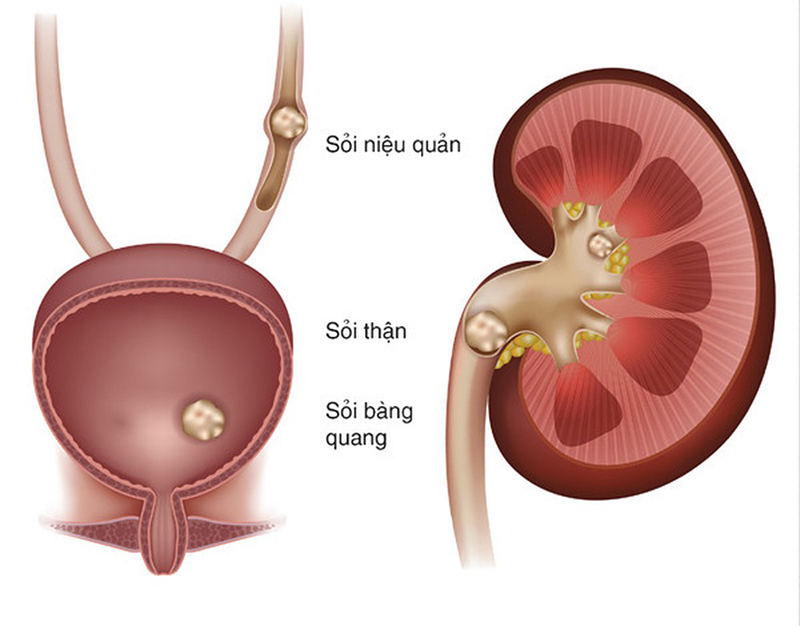 Hình ảnh sỏi sỏi đường tiết niệu