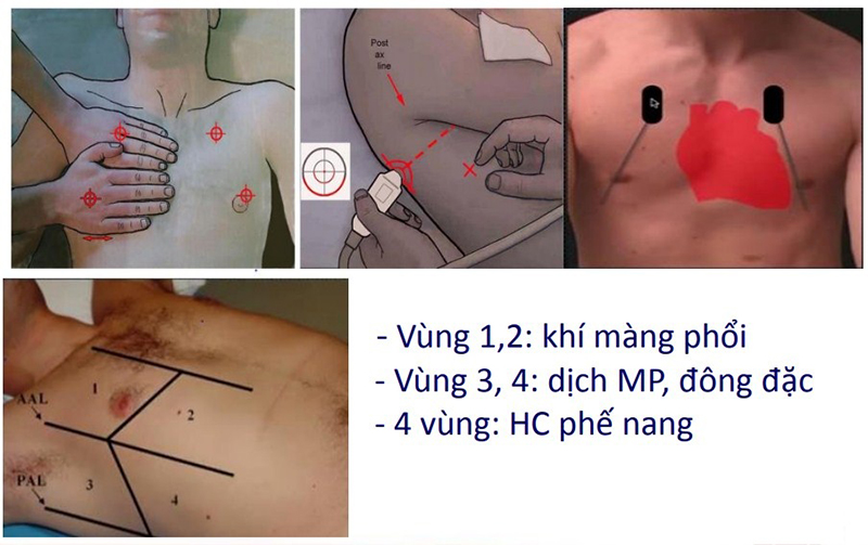 Các vị trí đặt đầu dò khi thực hiện siêu âm phổi