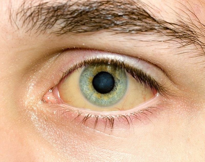 Hình ảnh vàng mắt ở người bệnh viêm gan virut B