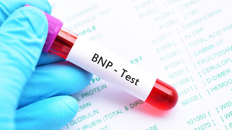 Xét nghiệm NT-pro BNP, dấu ấn không thể thiếu trong chẩn đoán bệnh suy tim | Medlatec