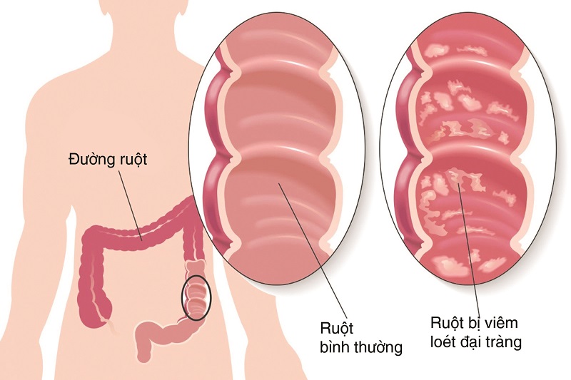 Xét nghiệm máu ẩn trong phân giúp tầm soát các bệnh liên quan đến đường tiêu hóa.