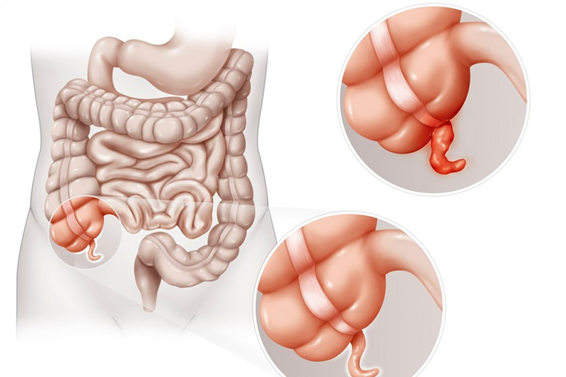 Hình ảnh minh họa ruột thừa trong hệ tiêu hóa