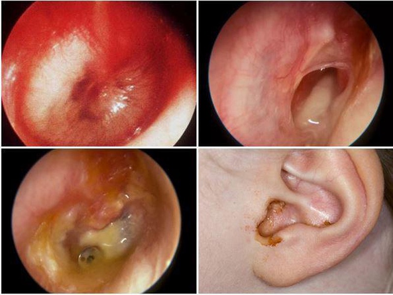 Bệnh viêm tai giữa có thể gây ra biến chứng nguy hiểm nếu không được phát hiện, điều trị kịp thời