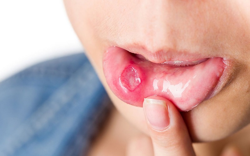 Hình ảnh loét miệng ở người bị tay chân miệng