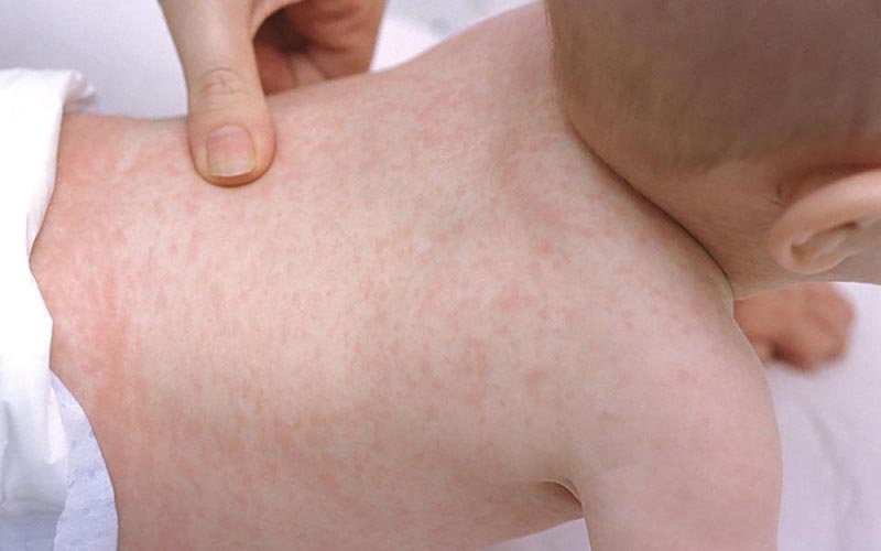 Sốt phát ban điển hình bởi cơn nóng sốt và xuất hiện các nốt ban trên da
