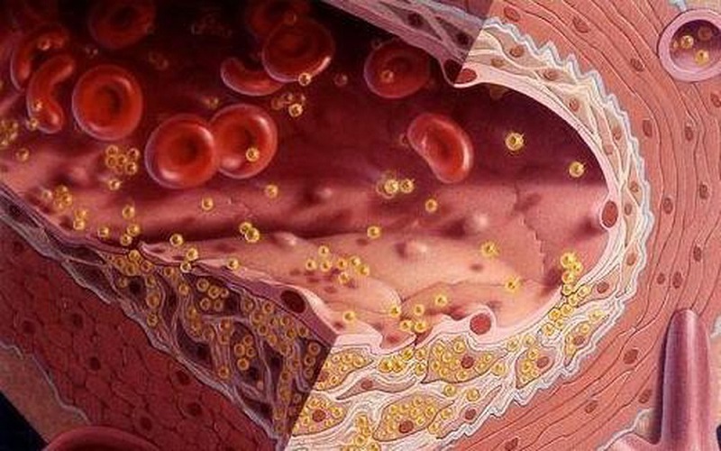 Bệnh mỡ máu là gì, có nguy hiểm không? – Xét nghiệm MEDLATEC
