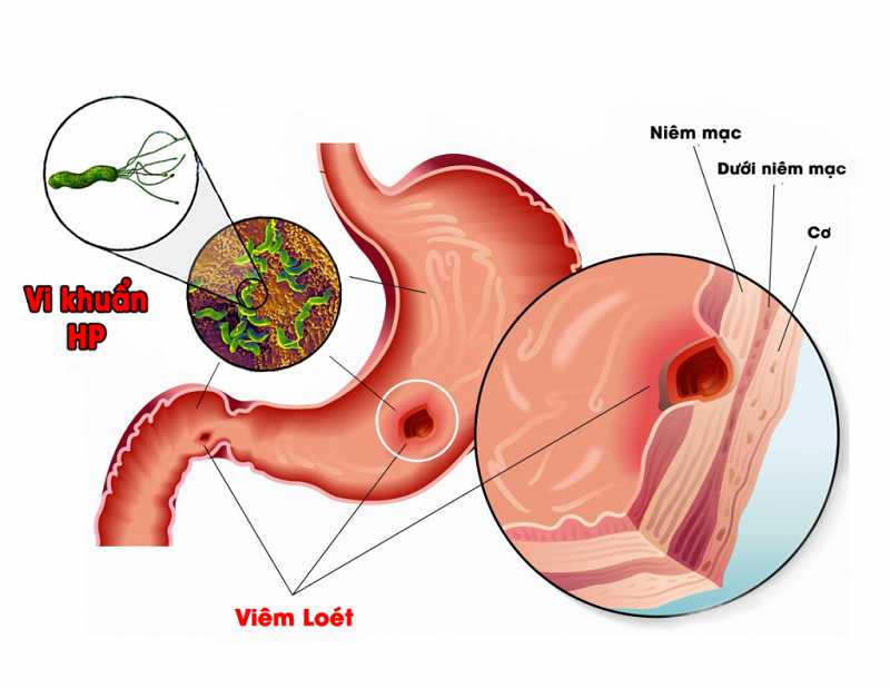 Helicobacter pylori có thể gây viêm loét dạ dày - tá tràng