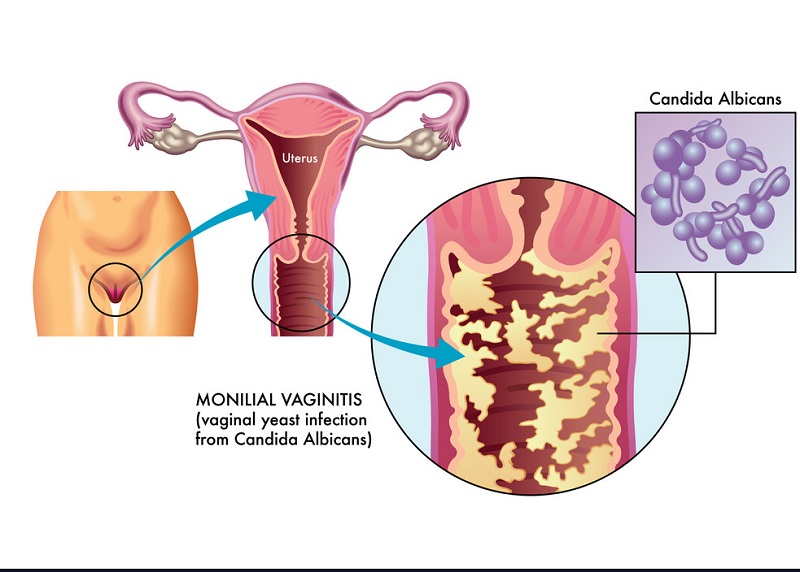 Âm đạo tăng tiết dịch do nhiễm nấm Candida