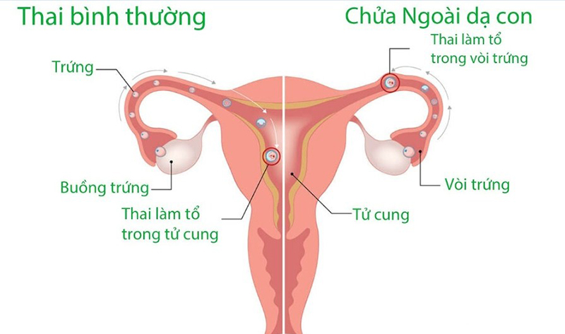 Các trường hợp mang thai ngoài tử cung sẽ cho kết quả xét nghiệm beta hCG giảm