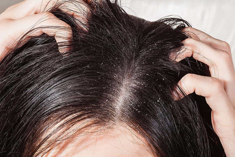 Gàu là biểu hiện đầu tiên khi nấm xâm nhập vào da đầu