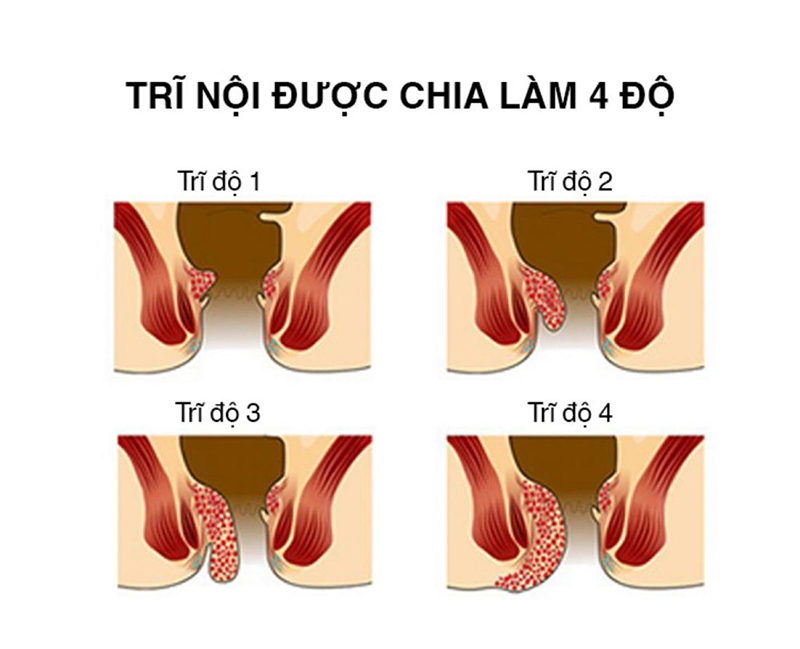 Các cấp độ của bệnh trĩ nội