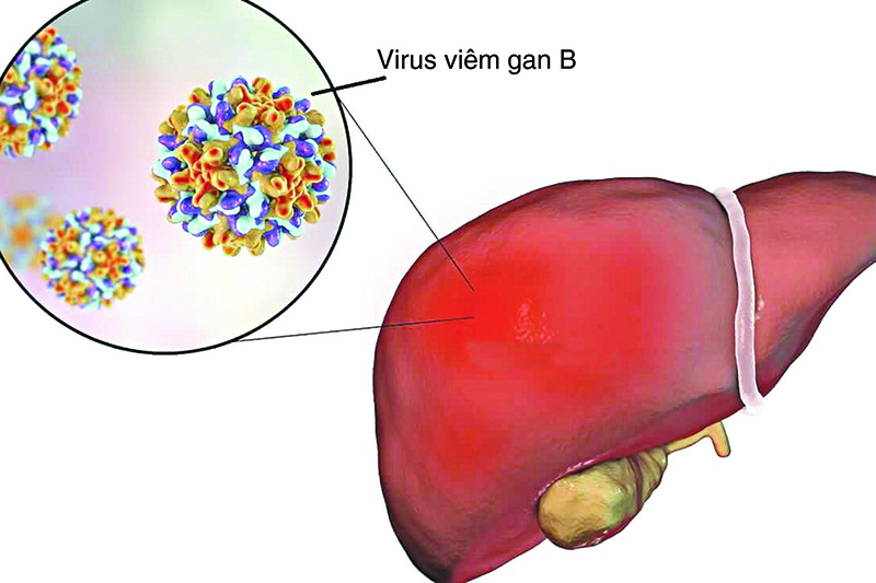 Virus HBV - tác nhân gây bệnh viêm gan B nguy hiểm