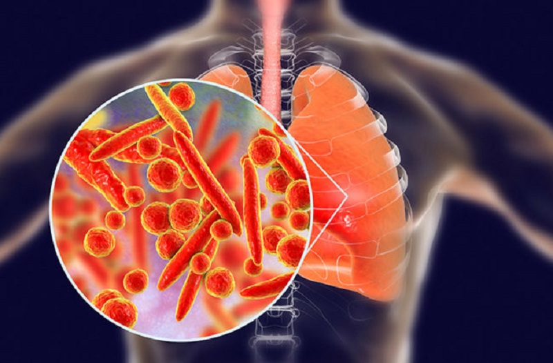 Hình ảnh minh họa viêm phổi do L.pneumophila