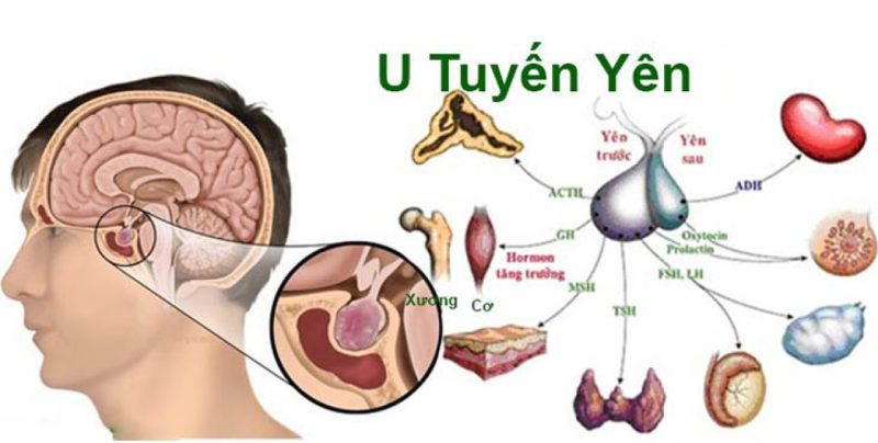 U tuyến yên cũng là nguyên nhân gây ra giảm sản xuất hormon tăng trưởng