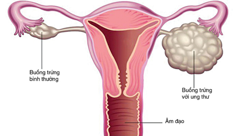 Buồng trứng bình thường và bất thường