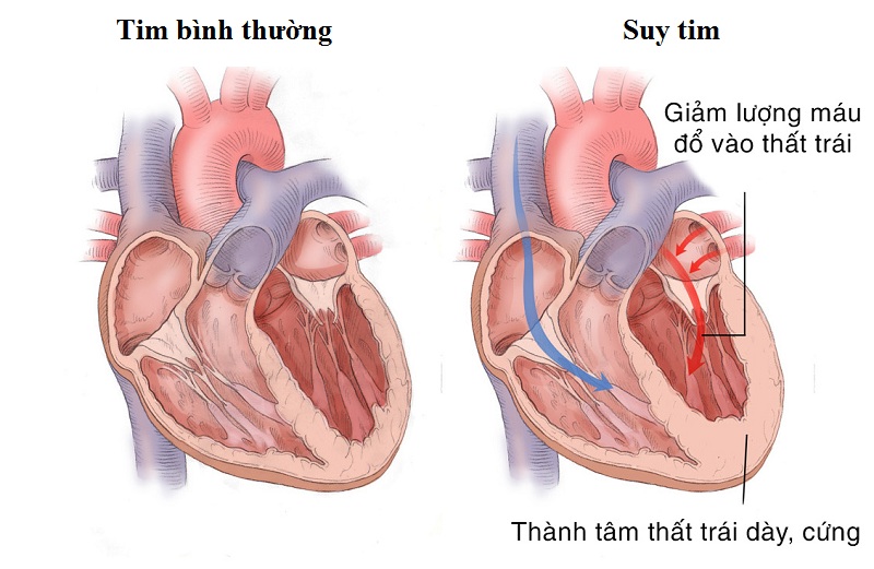 Xét nghiệm BNP giúp đánh giá hoạt động của tim gặp trong các bệnh lý mắc phải