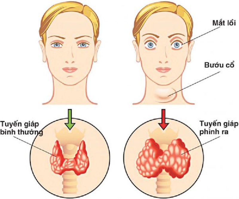 Dấu hiệu đặc trưng của bệnh Basedow