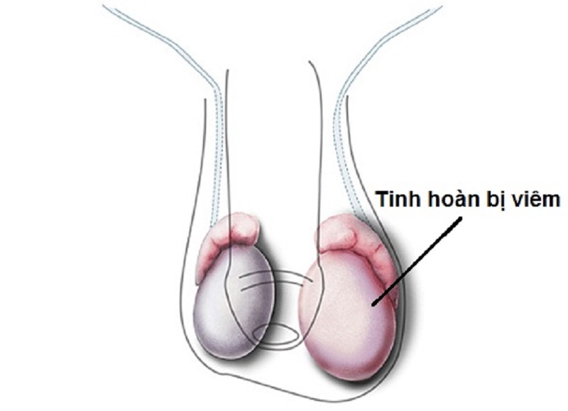 Nam giới có thể bị biến chứng viêm tinh hoàn sau quai bị