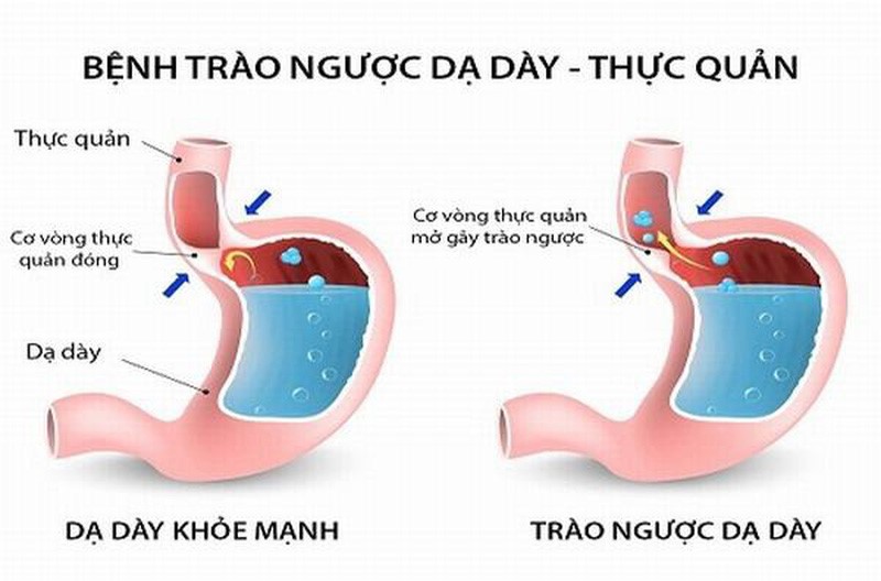 Bệnh trào ngược dạ dày thực quản