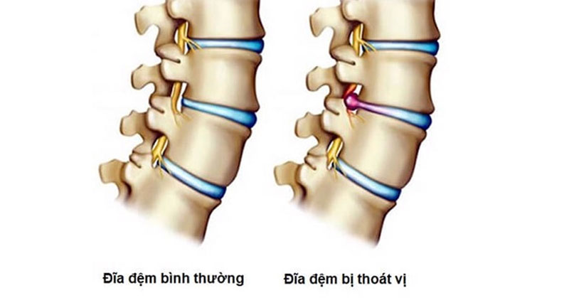 Thoát vị đĩa đệm thường xảy ra ở cột sống thắt lưng