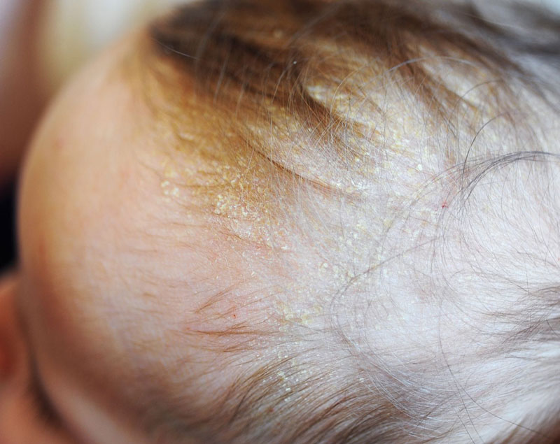 Viêm da tiết bã xuất hiện trên đầu trẻ sơ sinh