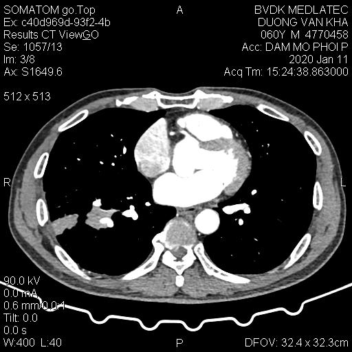 Ảnh chụp cắt lớp phát hiện tổn thương tại phổi