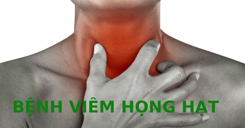 Viêm họng hạt cần xác định chính xác nguyên nhân