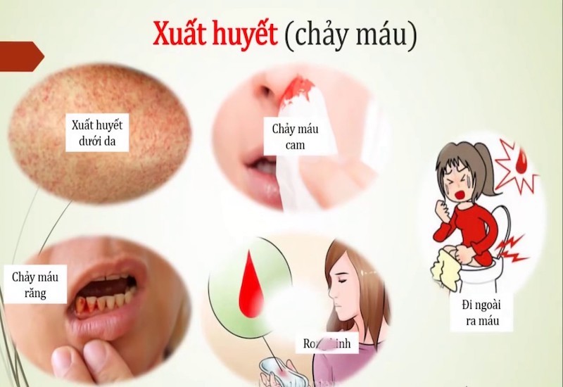 Dấu hiệu sốt xuất huyết