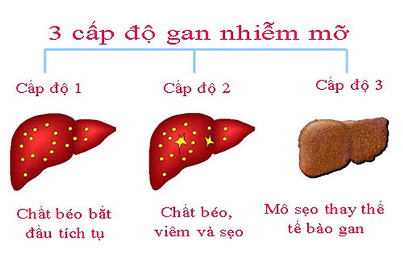 gan nhiễm mỡ