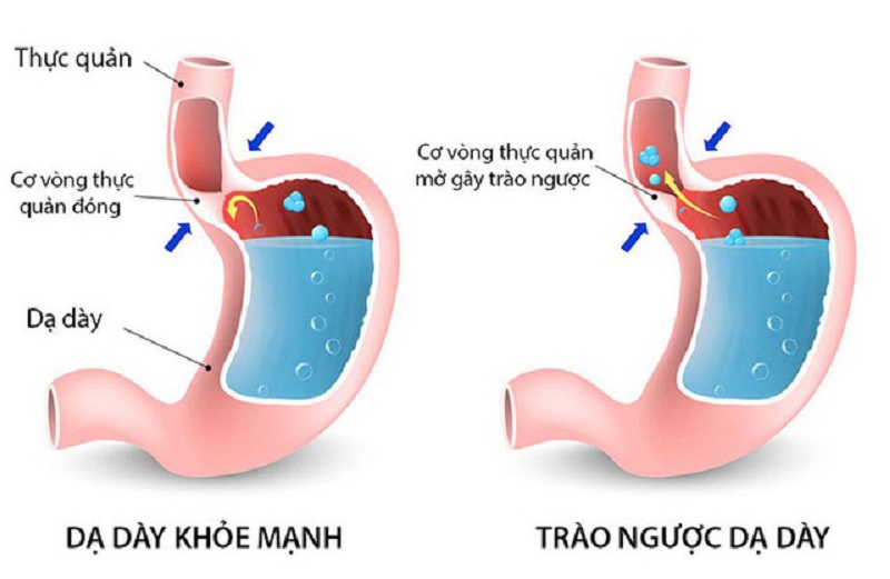 Khi cơ vòng thực quản không được đóng lại như bình thường sẽ sinh ra trào ngược dạ dày