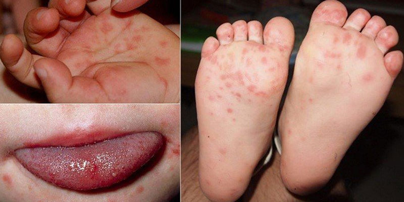 Nhận biết các dấu hiệu bệnh tay chân miệng ở trẻ em sớm