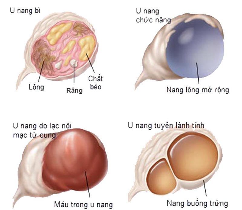 Phân loại u nang buồng trứng