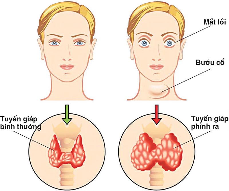 Đa nhân tuyến giáp kiêng ăn gì? Bí quyết ăn uống để bảo vệ sức khỏe