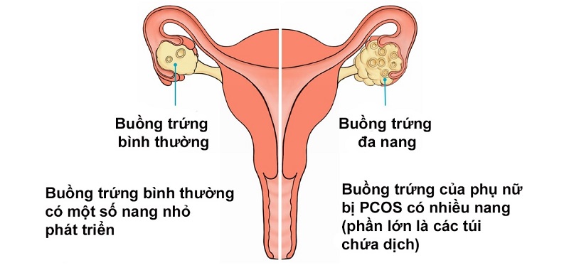 Điều trị rối loạn kinh nguyệt