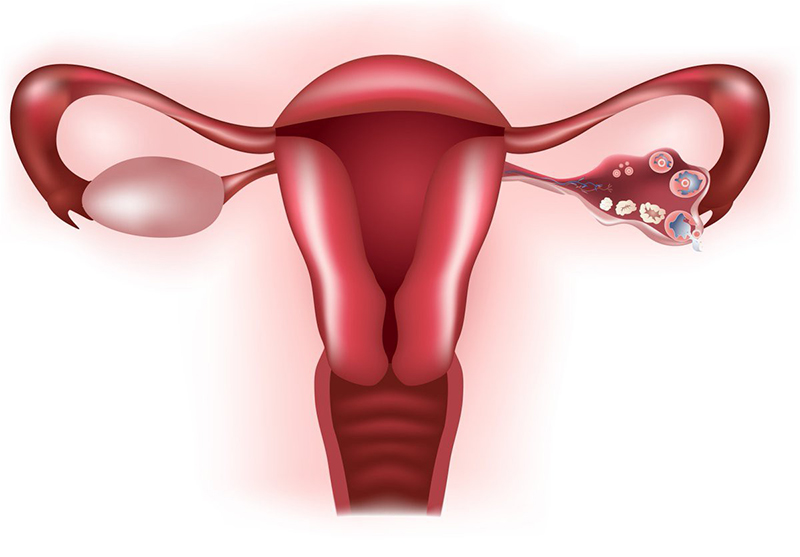 Tắc vòi vĩnh trứng là hiện tượng bịt hẹp đường đi trứng trứng cho tới thực hiện tổ bên trên tử cung