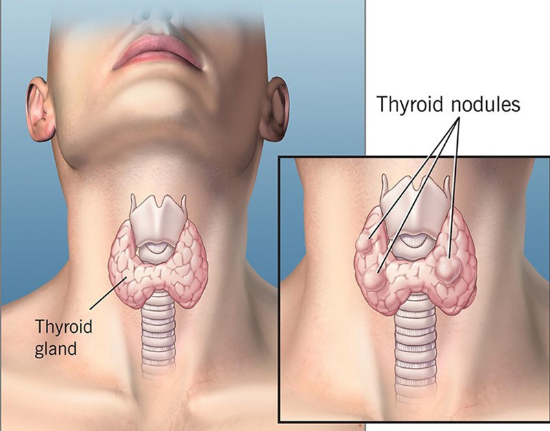 Nang Kéo Tuyến Giáp 4mm: Nguyên Nhân, Dấu Hiệu và Cách Điều Trị Hiệu Quả