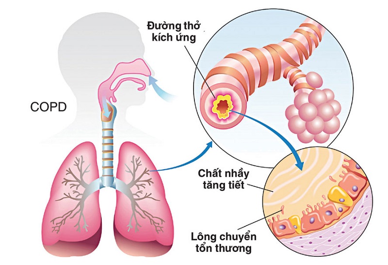 khó thở khi ngủ