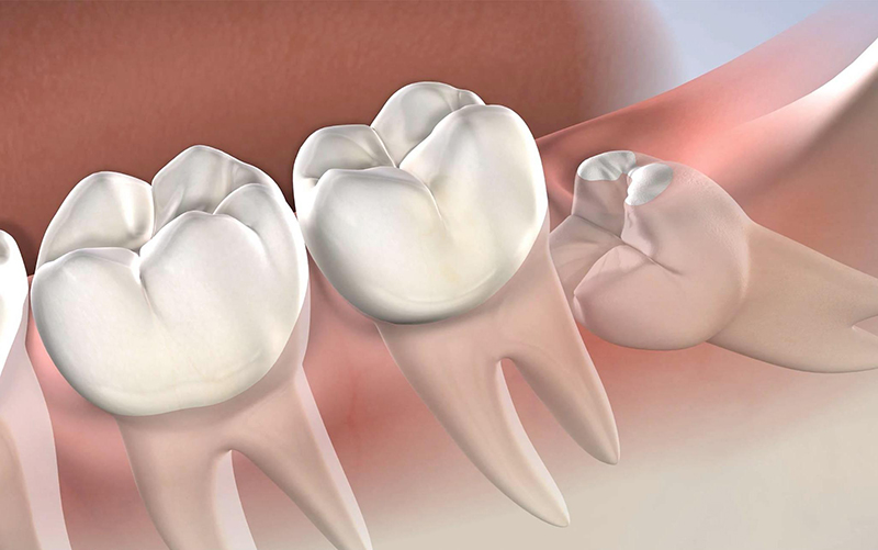 Răng khôn: Những biến chứng thường gặp và lưu ý quan trọng sau nhổ | Medlatec