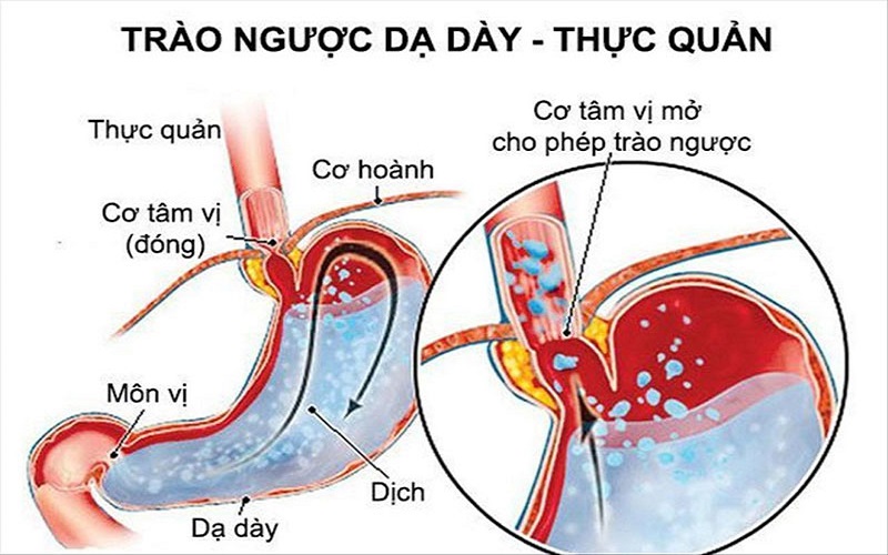 tức ngực, khó thở là bệnh gì