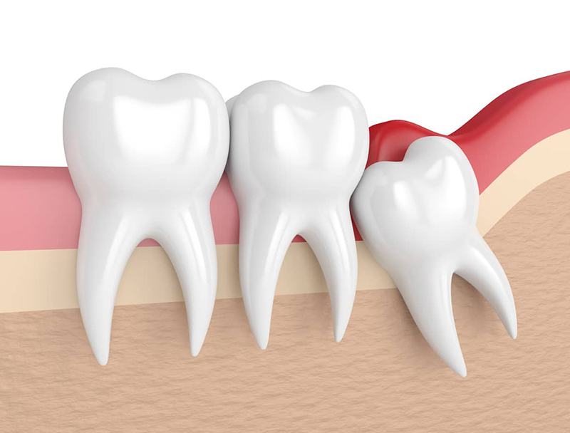 Răng khôn hay còn gọi là răng số 8 mọc ở người trưởng thành