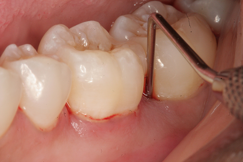 Sưng lợi là một trong những dấu hiệu thường gặp của mọc răng khôn