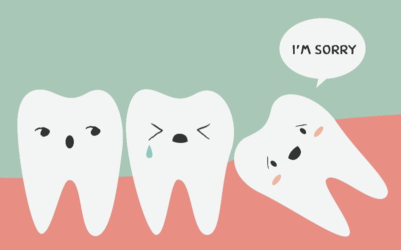 răng khôn được nhổ khi chúng có hình dạng hoặc chân răng bất thường