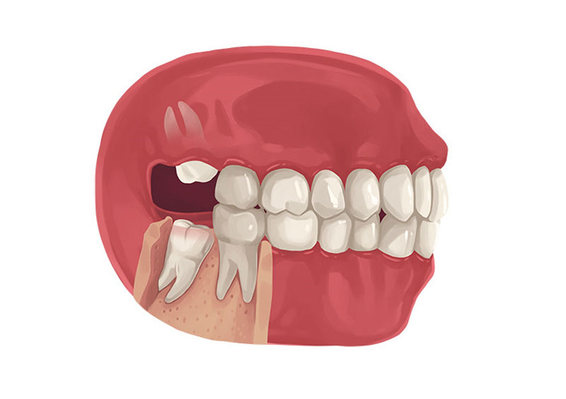 Răng khôn là gì và những trường hợp cần nhổ bỏ răng khôn?