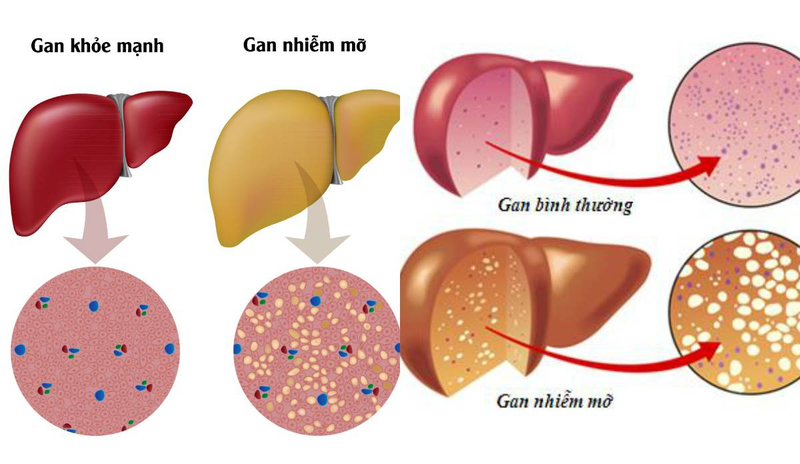 <a href='https://medlatec.vn/tin-tuc/cac-phuong-phap-dieu-tri-gan-nhiem-mo-hieu-qua-nhat-hien-nay-s67-n19594'  title ='Gan nhiễm mỡ điều trị'>Gan nhiễm mỡ điều trị</a> cần thực hiện từ giai đoạn sớm