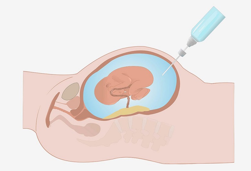 chọc ối giúp chẩn đoán thalassemia trước sinh